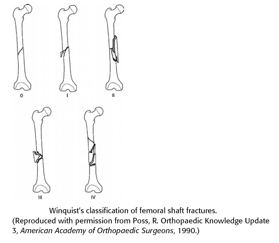 Femoral shaft fractures - Winquist classification - OrthopaedicsOne ...